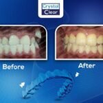 صورة قبل وبعد تُظهر تحسّن ترتيب الأسنان وتناسقها بعد علاج التقويم الشفاف (Clear Aligners) في عيادة كريستال كلير.