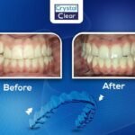 صورة قبل وبعد تُظهر تحسّن ترتيب الأسنان وتناسقها بعد علاج التقويم الشفاف (Clear Aligners) في عيادة كريستال كلير.