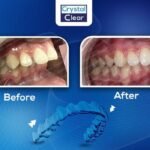 صورة قبل وبعد تُظهر تحسّن ترتيب الأسنان وتناسقها بعد علاج التقويم الشفاف (Clear Aligners) في عيادة كريستال كلير.