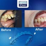 صورة قبل وبعد تُظهر تحسّن ترتيب الأسنان وتناسقها بعد علاج التقويم الشفاف (Clear Aligners) في عيادة كريستال كلير.