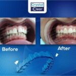 صورة قبل وبعد تُظهر تحسّن ترتيب الأسنان وتناسقها بعد علاج التقويم الشفاف (Clear Aligners) في عيادة كريستال كلير.