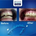 صورة قبل وبعد تُظهر تحسّن ترتيب الأسنان وتناسقها بعد علاج التقويم الشفاف (Clear Aligners) في عيادة كريستال كلير.