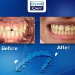 صورة قبل وبعد تُظهر تحسّن ترتيب الأسنان وتناسقها بعد علاج التقويم الشفاف (Clear Aligners) في عيادة كريستال كلير.