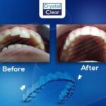 صورة قبل وبعد تُظهر تحسّن ترتيب الأسنان وتناسقها بعد علاج التقويم الشفاف (Clear Aligners) في عيادة كريستال كلير.