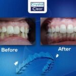 صورة قبل وبعد تُظهر تحسّن ترتيب الأسنان وتناسقها بعد علاج التقويم الشفاف (Clear Aligners) في عيادة كريستال كلير.