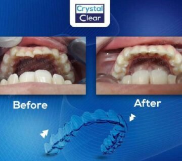 التقويم الشفاف