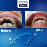 صورة قبل وبعد تُظهر تحسّن ترتيب الأسنان وتناسقها بعد علاج التقويم الشفاف (Clear Aligners) في عيادة كريستال كلير.