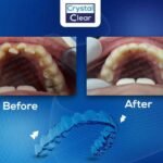 صورة قبل وبعد تُظهر تحسّن ترتيب الأسنان وتناسقها بعد علاج التقويم الشفاف (Clear Aligners) في عيادة كريستال كلير.