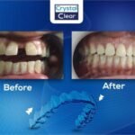 التقويم الشفاف قبل وبعد