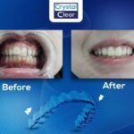 صورة قبل وبعد تُظهر تحسّن ترتيب الأسنان وتناسقها بعد علاج التقويم الشفاف (Clear Aligners) في عيادة كريستال كلير.