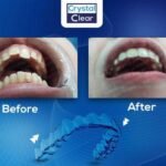 صورة قبل وبعد تُظهر تحسّن ترتيب الأسنان وتناسقها بعد علاج التقويم الشفاف (Clear Aligners) في عيادة كريستال كلير.