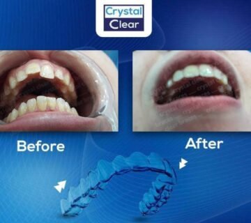 هل التقويم الأسنان الشفاف أغلى ؟