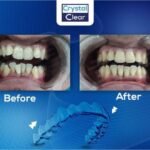 صورة قبل وبعد تُظهر تحسّن ترتيب الأسنان وتناسقها بعد علاج التقويم الشفاف (Clear Aligners) في عيادة كريستال كلير.