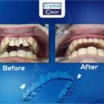 صورة قبل وبعد تُظهر تحسّن ترتيب الأسنان وتناسقها بعد علاج التقويم الشفاف (Clear Aligners) في عيادة كريستال كلير.