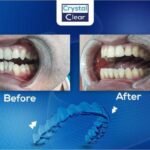 صورة قبل وبعد تُظهر تحسّن ترتيب الأسنان وتناسقها بعد علاج التقويم الشفاف (Clear Aligners) في عيادة كريستال كلير.