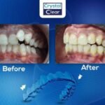 صورة قبل وبعد تُظهر تحسّن ترتيب الأسنان وتناسقها بعد علاج التقويم الشفاف (Clear Aligners) في عيادة كريستال كلير.