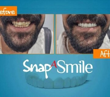 تقويم الأسنان الشفاف صور قبل و بعد