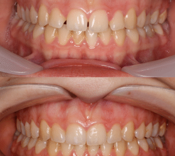 التقويم الشفاف أم الفينير