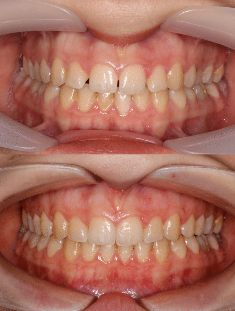 التقويم الشفاف أم الفينير